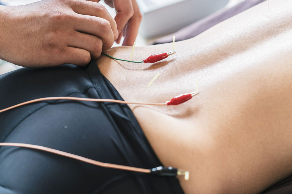 Electro Dry Needling  Al Das Medical Clinic